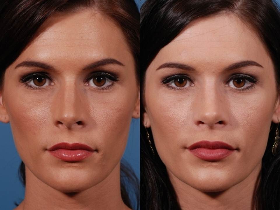 Rhinoplasty of the nose: indications and contraindications