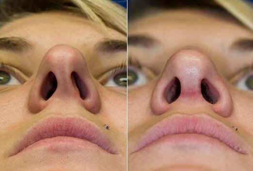 Consequences of the curvature of the nasal septum