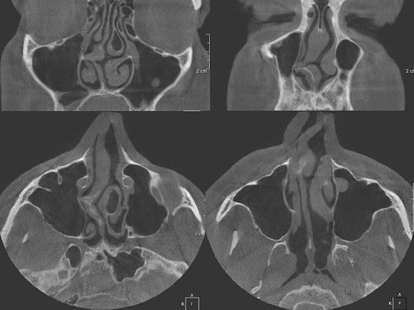 X-ray of a curved nasal septum