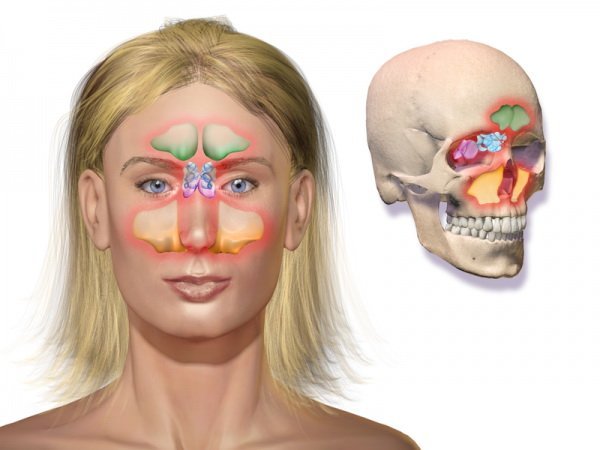 The development of sinusitis and sinusitis due to a curved nasal septum