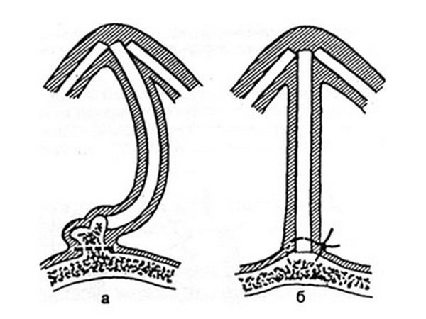 Curved cartilage fragment of the nasal septum