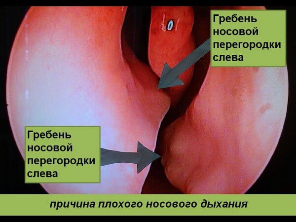 The presence of a crest in the nose - the cause of obstructed nasal breathing