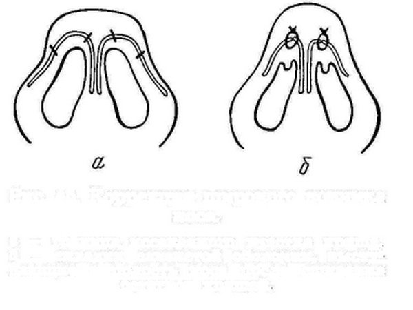 Schematic representation of the stitching of the cartilage of the tip of the nose