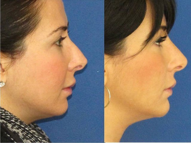 Correction of the tip of the nose with the help of gel preparations