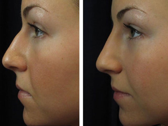 Nose Tip Correction Results