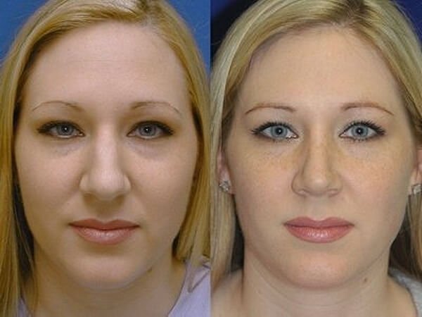 Rhinoplasty as an option to get rid of a big nose