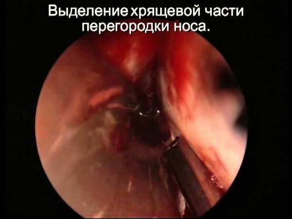 Isolation of the cartilage of the nasal septum when septoplasty