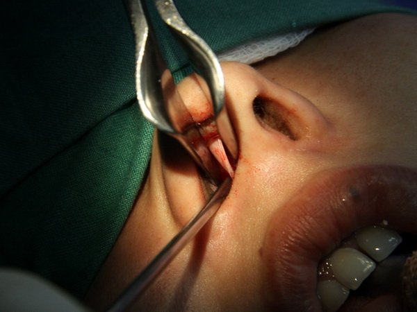 operation septoplasty