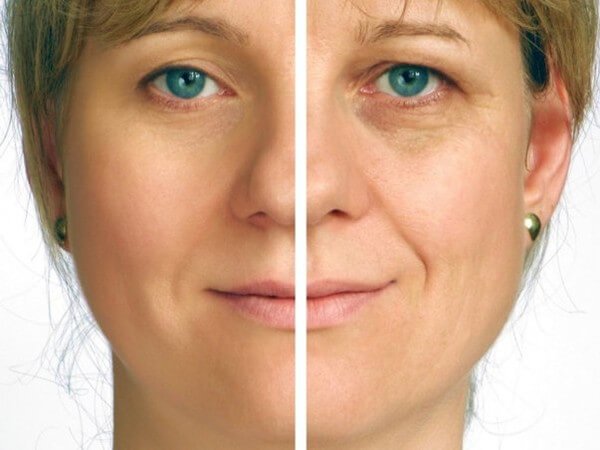 How to remove wrinkles around the eyes