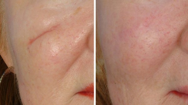 Removal of the scar by laser polishing