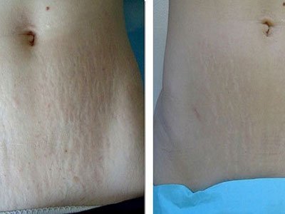 Removal of stretch marks on the abdomen