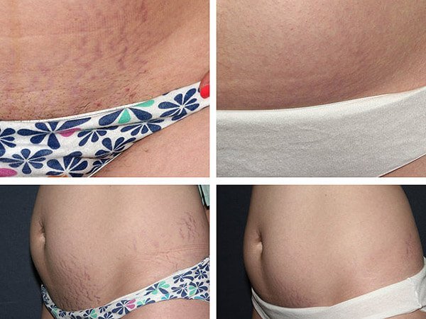 Laser removal of stretch marks