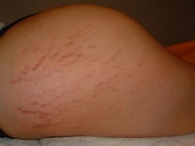 Removal of stretch marks with a laser on the hips