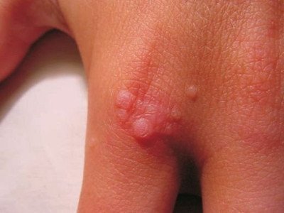 Wart on hand