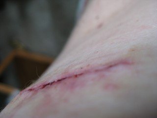 Excision of moles: stitches