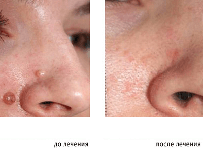 Mole removal: before and after