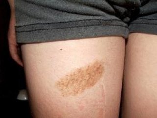 Birthmark removal