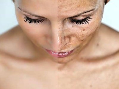 Cosmetics in removing pigment spots