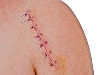 Treatment of scars after surgery