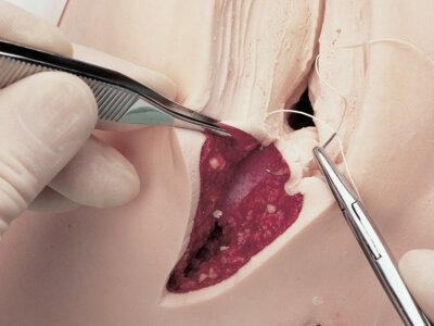 Stitches after vaginal plastics