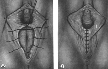 Conducting vaginal plasty after childbirth